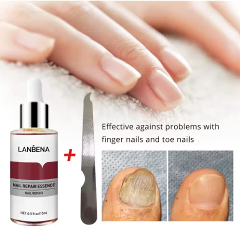 LANBENA Fungus Care Remove Onychomycosis, nail fungus