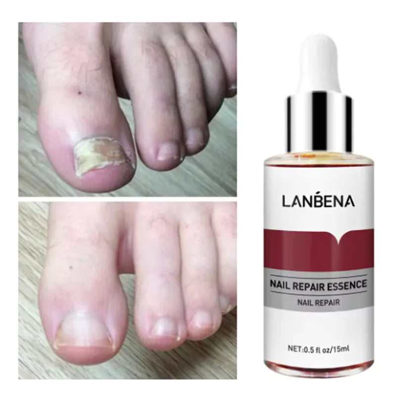 LANBENA Fungus Care Remove Onychomycosis, nail fungus