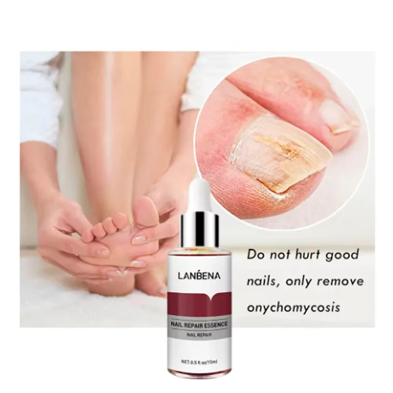 LANBENA Fungus Care Remove Onychomycosis, nail fungus