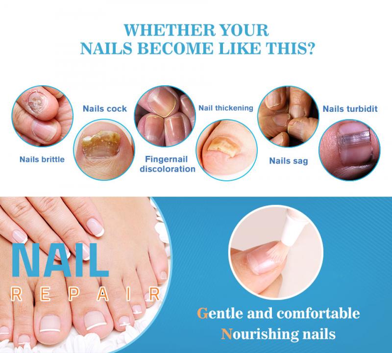 Fungal Nail Treatments Pen