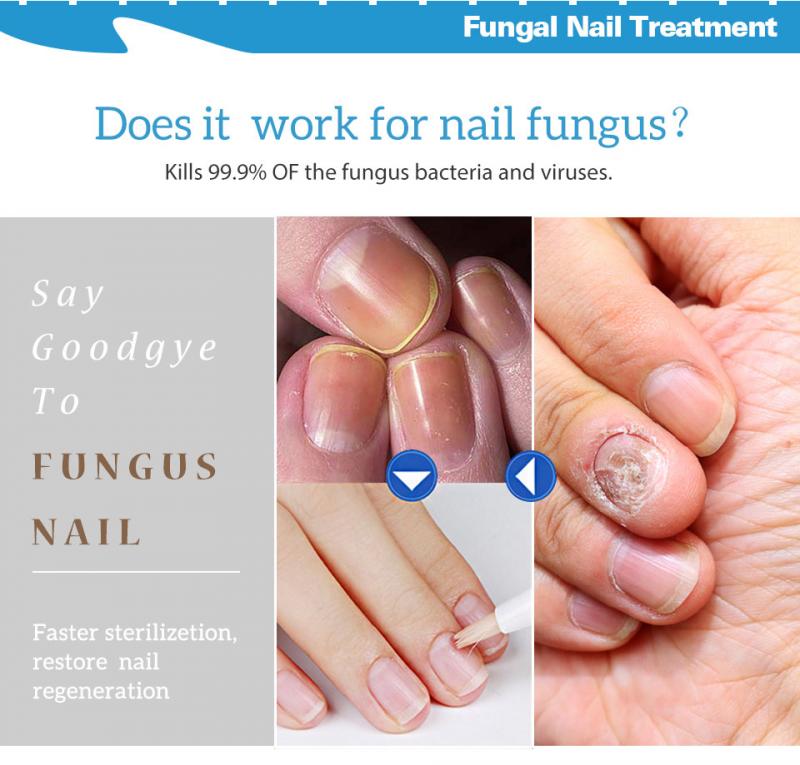 Fungal Nail Treatments Pen